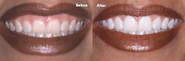 zoom teeth whitening near vienna