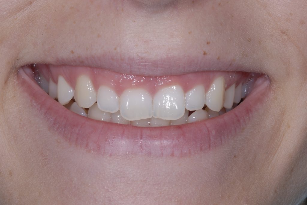 Gum Lift-gallery - Tysons Aesthetic Dentistry