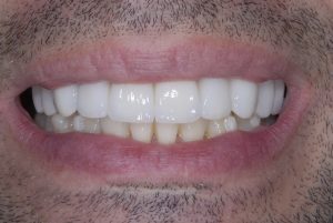 Porcelain Veneers Treatment