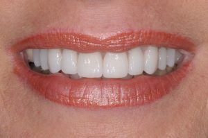 Porcelain Veneers Treatment Cost