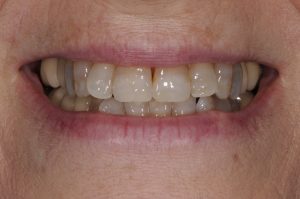 Porcelain Veneers Treatment VA