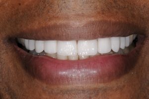 Porcelain Veneers Treatment Tyson