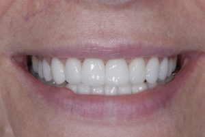 Porcelain Veneers Treatment