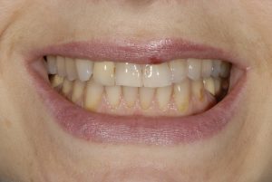 Porcelain Veneers Treatment