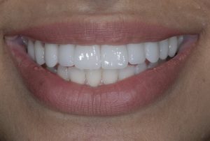 Porcelain Veneers Vienna