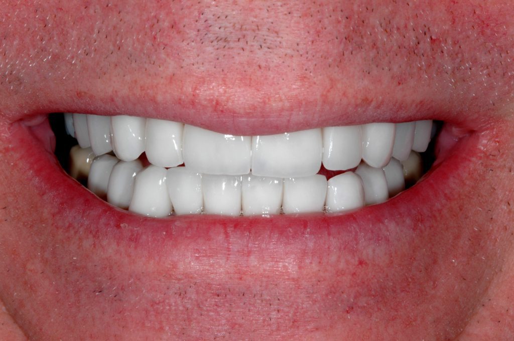 Laser teeth whitening images