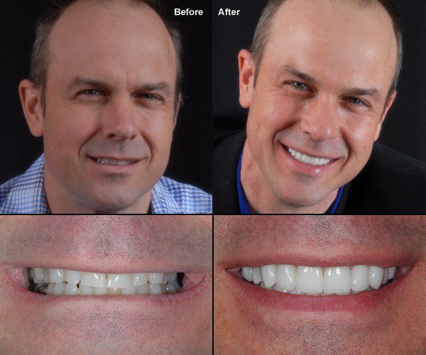 Porcelain Veneers