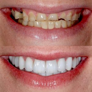 porcelain Veneers and Crowns option 3