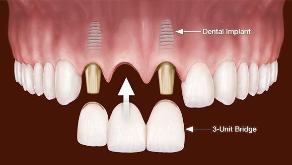 Tooth Replacement and Bridges