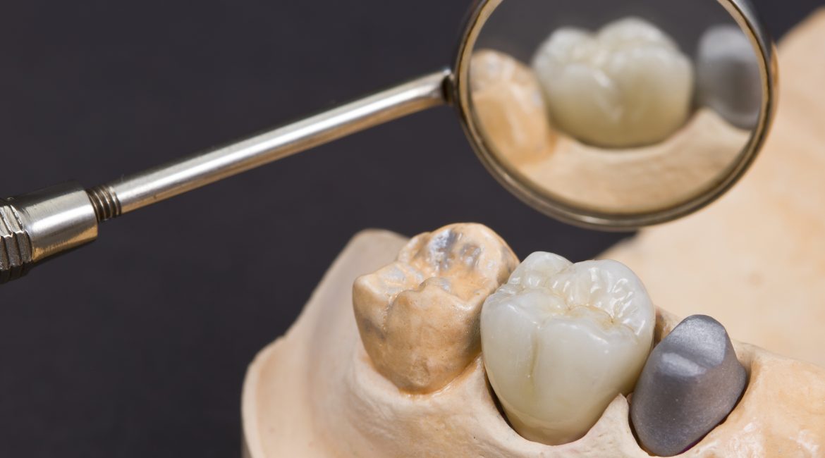 Dental Crowns