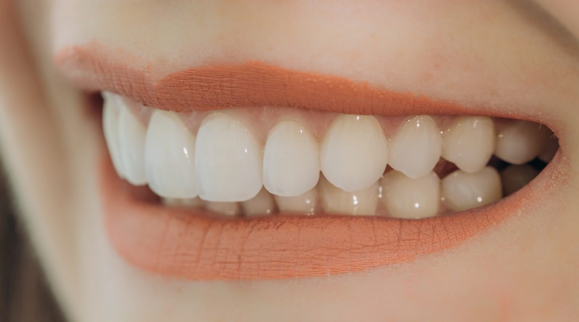 Porcelain Veneers