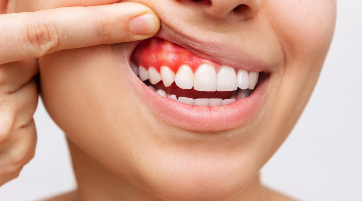 Importance of Gum Health